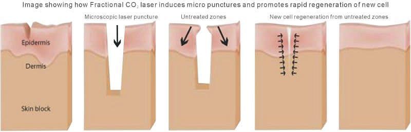 Image showing how Fraction CO2 laser induces micro punctures and promotes rapid regeneration of new cell growth with Lumenis Accupulse CO2 Laser.