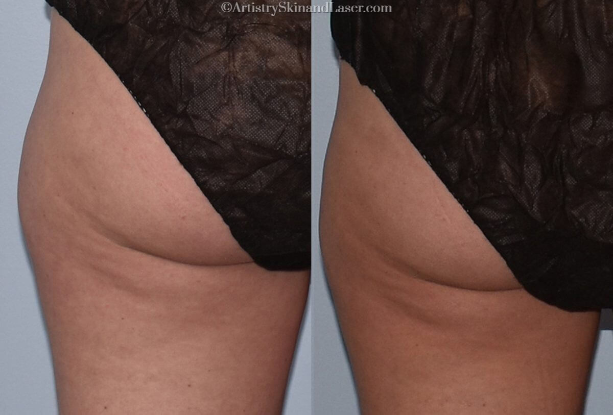 Before and after Coolsculpting treatment to butt and thighs at Artistry Skin & Laser.