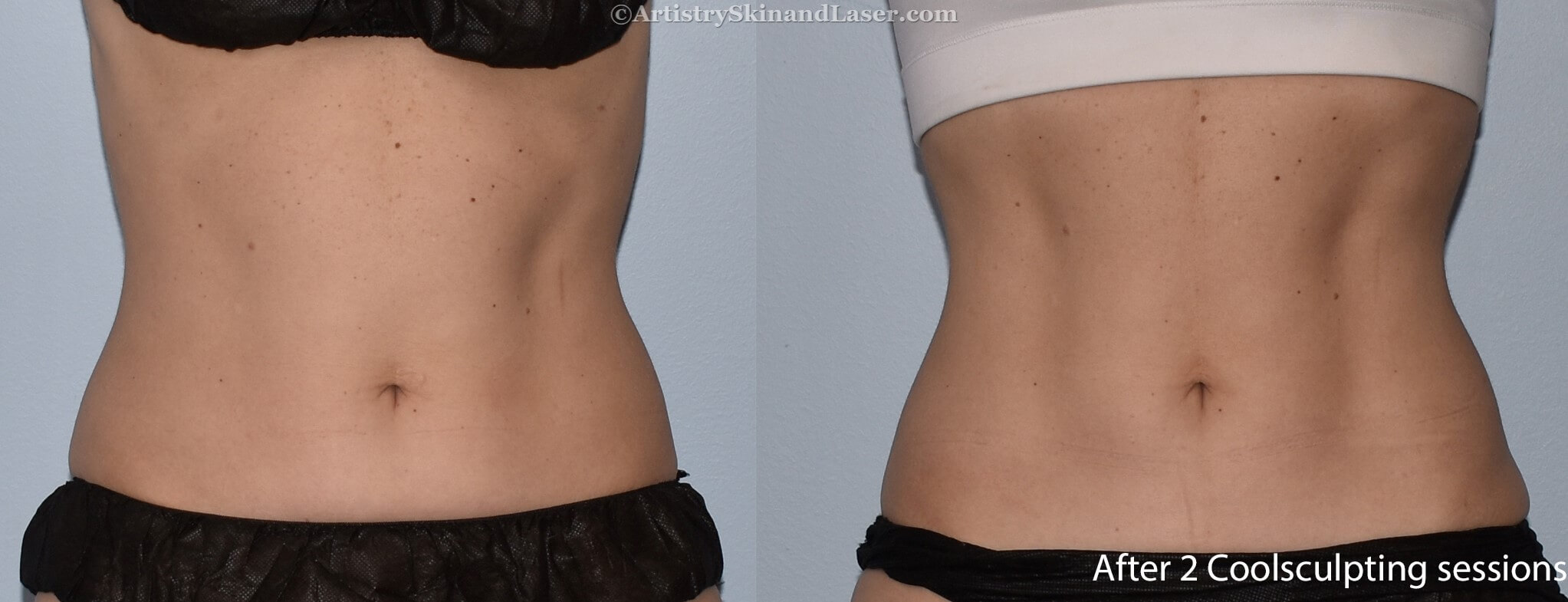 Woman's before and after Coolsculpting abdomen treatment at Artistry Skin & Laser.