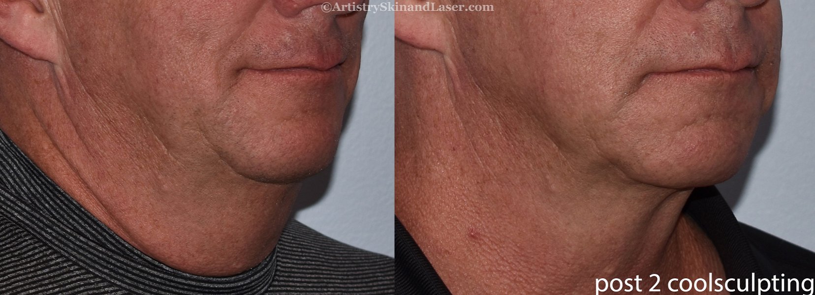 Man's before and after Coolsculpting chin treatment at Artistry Skin & Laser.