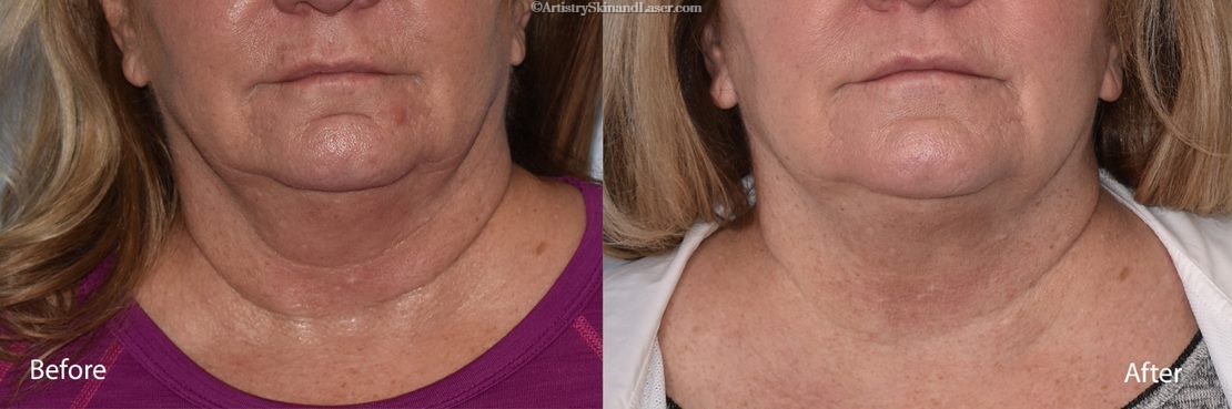 Woman's before and after Coolsculpting chin treatment at Artistry Skin & Laser.