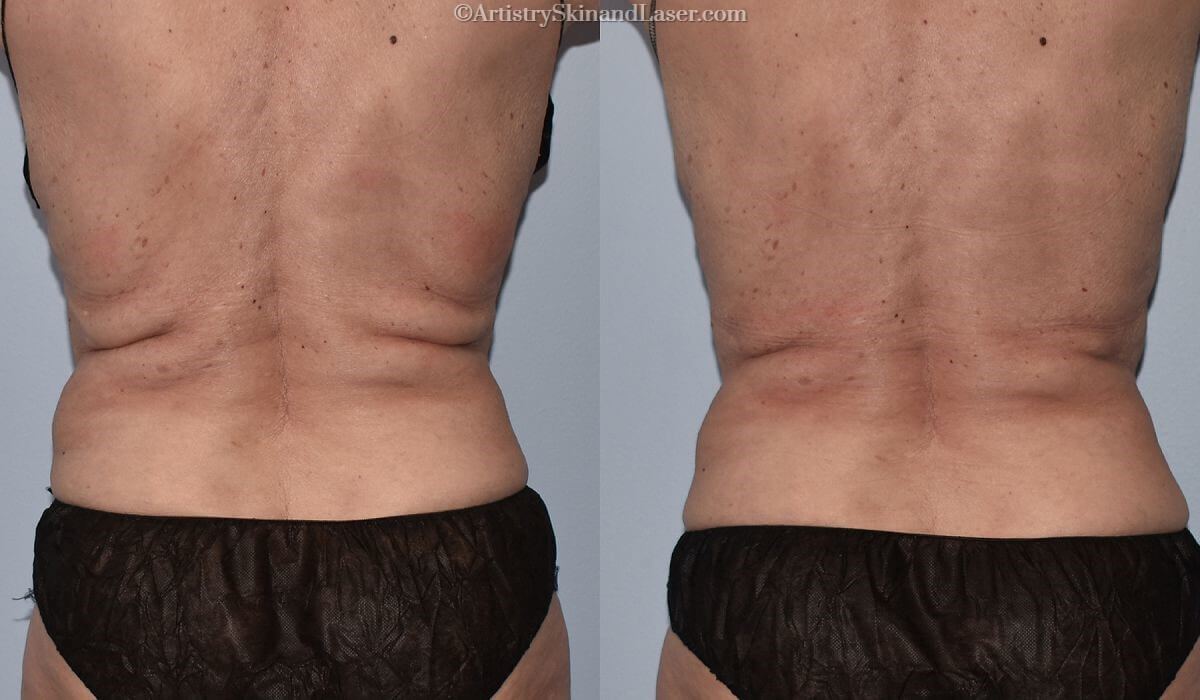 Before and after Coolsculpting treatment to the back at Artistry Skin & Laser.