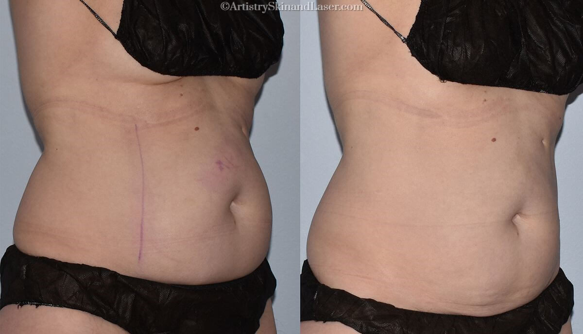 Before and after Coolsculpting treatment to the belly at Artistry Skin & Laser.