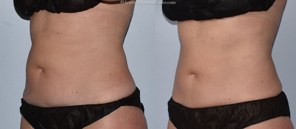 Woman's before and after Coolsculpting stomach treatment at Artistry Skin & Laser.