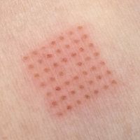 Image showing how the red dots in the grid are where the skin has been ablated. The non-red portions are intact skin. Treating the skin in this manner allows faster healing time and less complications with Lumenis Accupulse CO2 Laser.