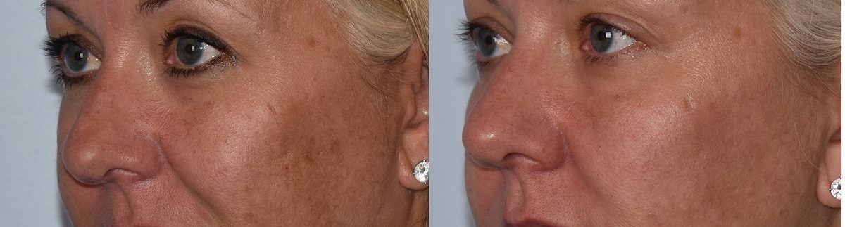 Woman's beautiful results from facials & peels treatment, chemical peel specifically, at Artistry Skin & Laser.